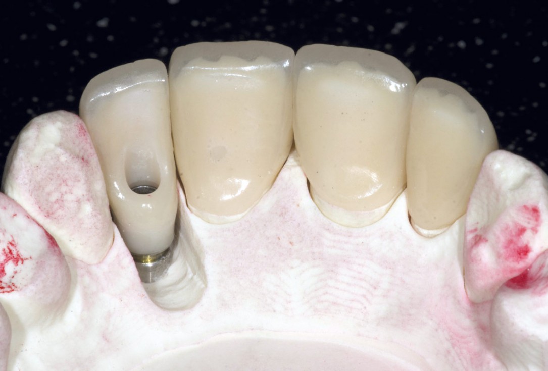 Bone augementation with maxresorb® - Dr. R. Cutts