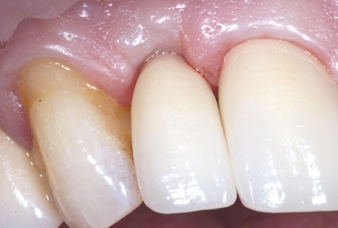 Bone augementation with maxresorb® - Dr. R. Cutts