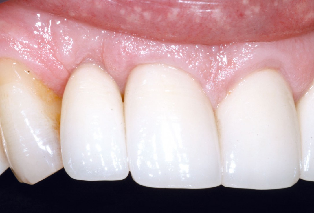 Bone augementation with maxresorb® - Dr. R. Cutts