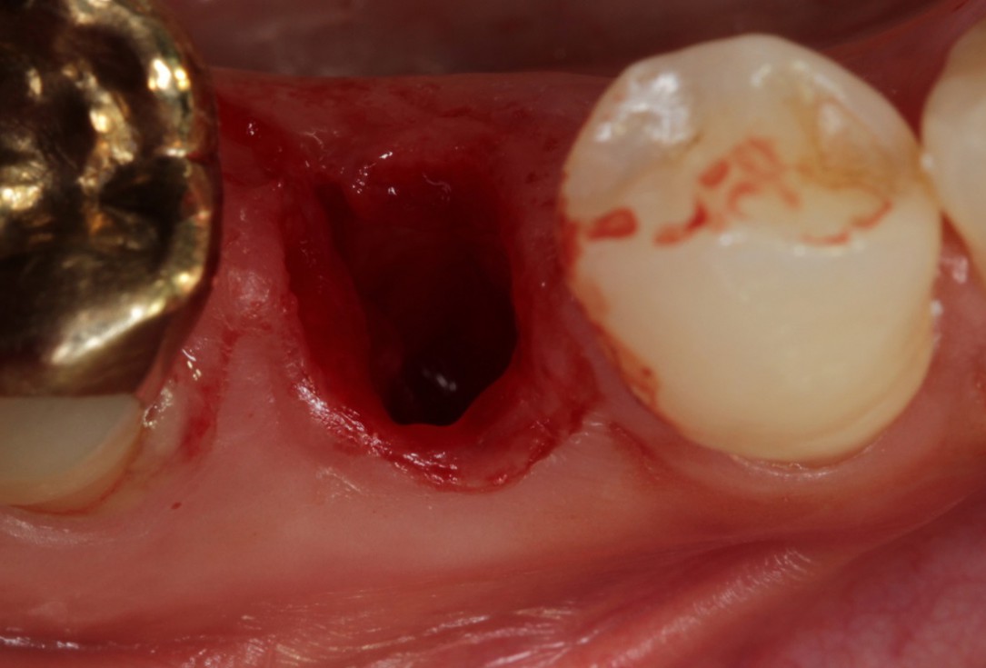Socket seal with mucoderm® for later implant placement - Dr. Michael Back