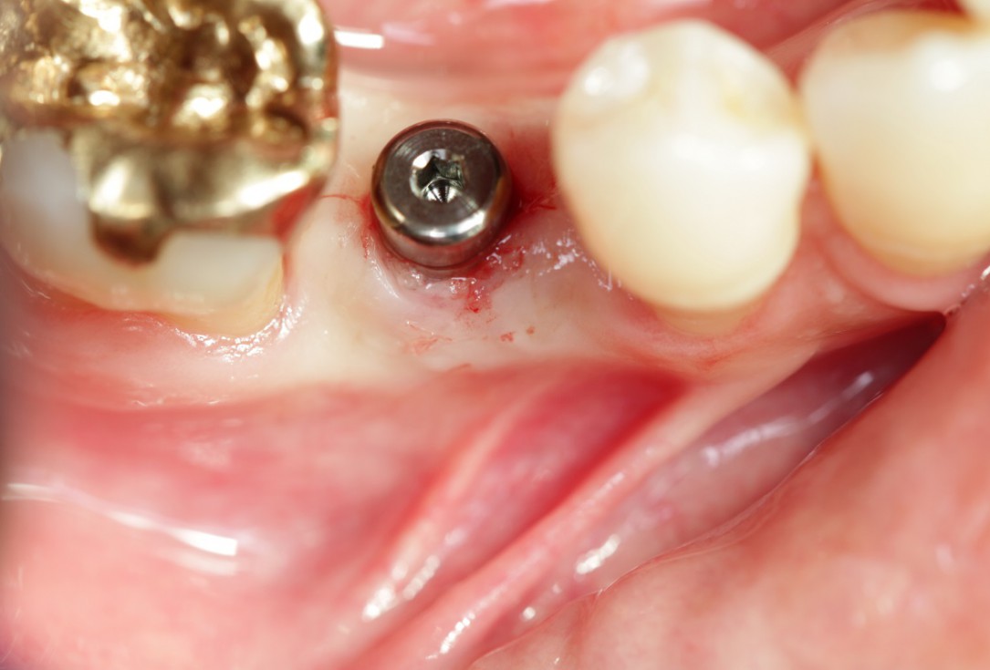 Socket seal with mucoderm® for later implant placement - Dr. Michael Back