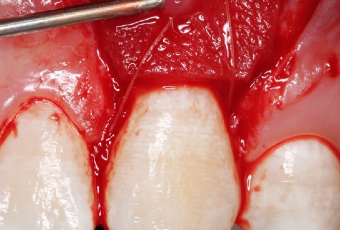 Isolated gingival recessions treated by CAF in conjunction with mucoderm® and Straumann® Emdogain® - Taba Jr