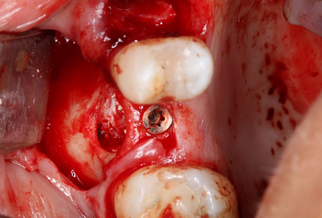 Sinus Floor Elevation with maxgraft® bonering - Dr. B. Giesenhagen