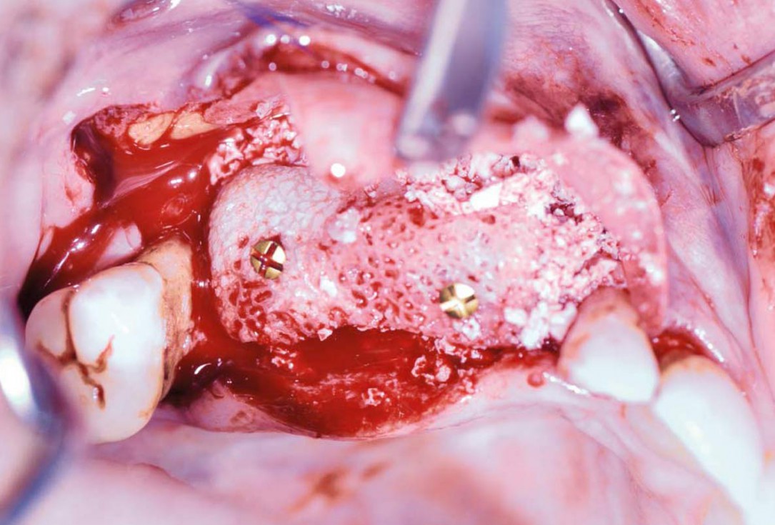 Ridge augmentation with maxgraft® bonebuilder and sinus floor elevation – Dr. K.P. Schiechl