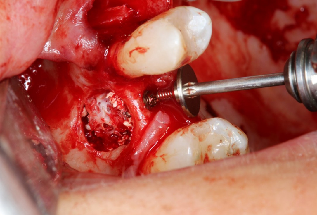 Sinus Floor Elevation with maxgraft® bonering - Dr. B. Giesenhagen