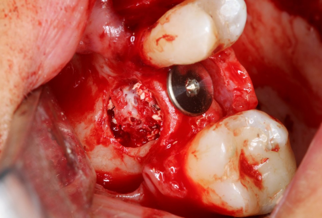 Sinus Floor Elevation with maxgraft® bonering - Dr. B. Giesenhagen