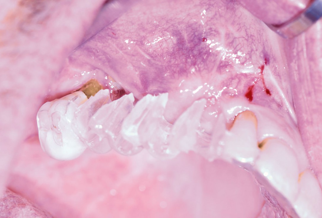 Ridge augmentation with maxgraft® bonebuilder and sinus floor elevation – Dr. K.P. Schiechl