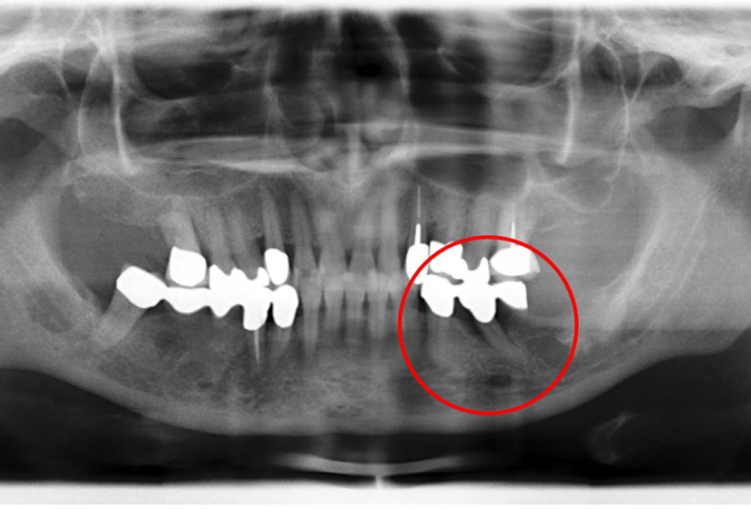 Contained intrabony defect treated using Straumann® Emdogain® - Kasaj