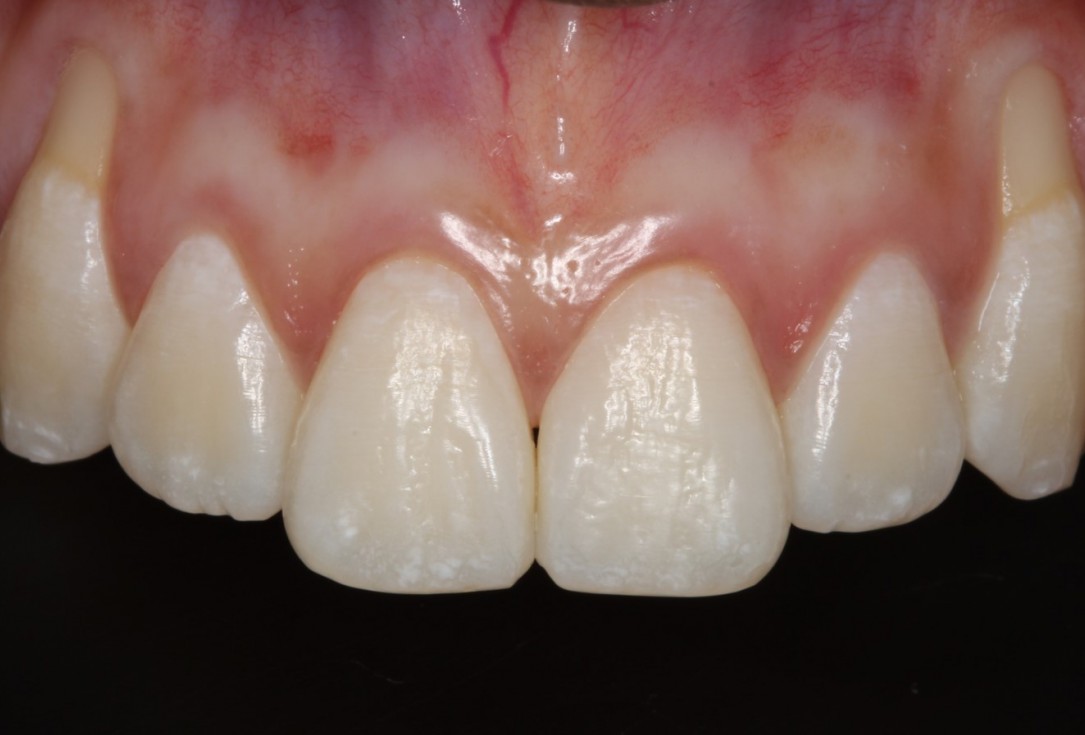 Isolated gingival recessions treated by CAF in conjunction with mucoderm® and Straumann® Emdogain® - Taba Jr