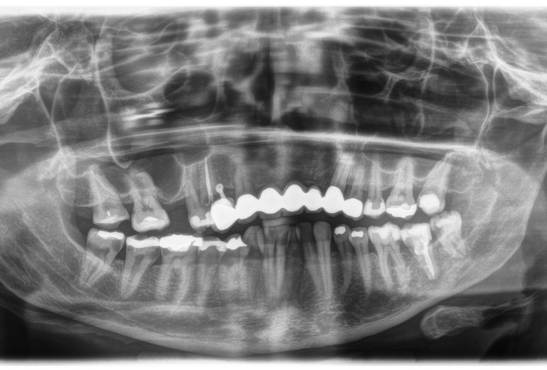 Sinus Floor Elevation with maxgraft® bonering - Dr. B. Giesenhagen
