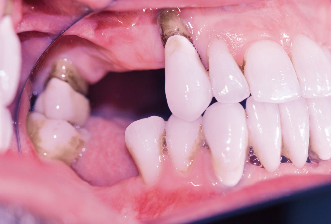 Ridge augmentation with maxgraft® bonebuilder and sinus floor elevation – Dr. K.P. Schiechl