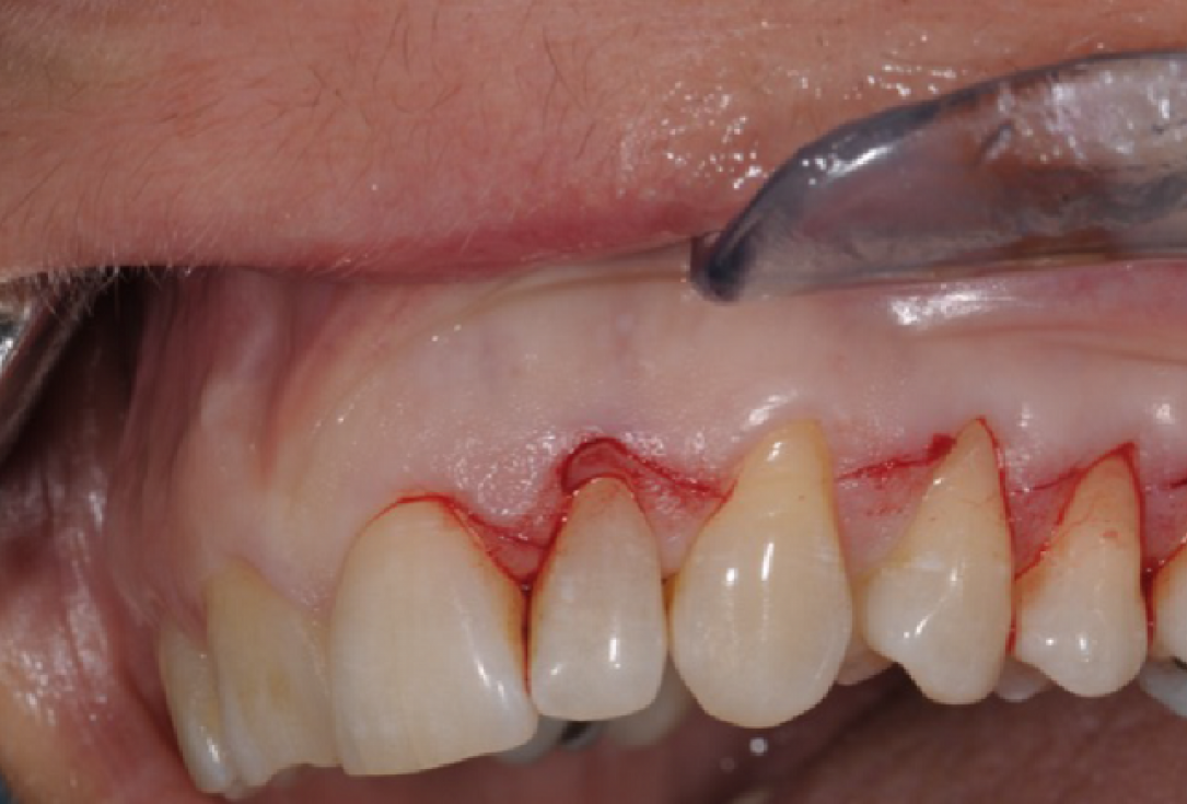 Multiple gingival recessions treated by MCAF in conjunction with mucoderm®, Straumann® Emdogain® and CTG - Benvenuto
