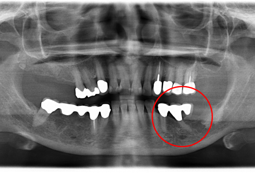 Contained intrabony defect treated using Straumann® Emdogain® - Kasaj 