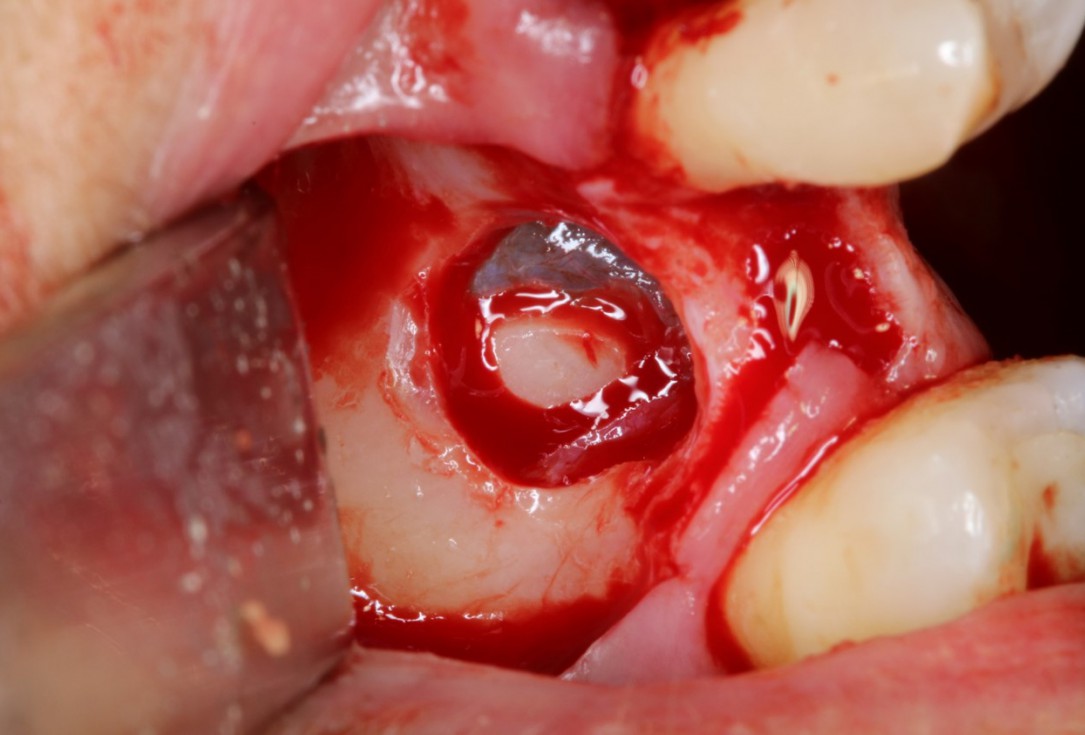 Sinus Floor Elevation with maxgraft® bonering - Dr. B. Giesenhagen
