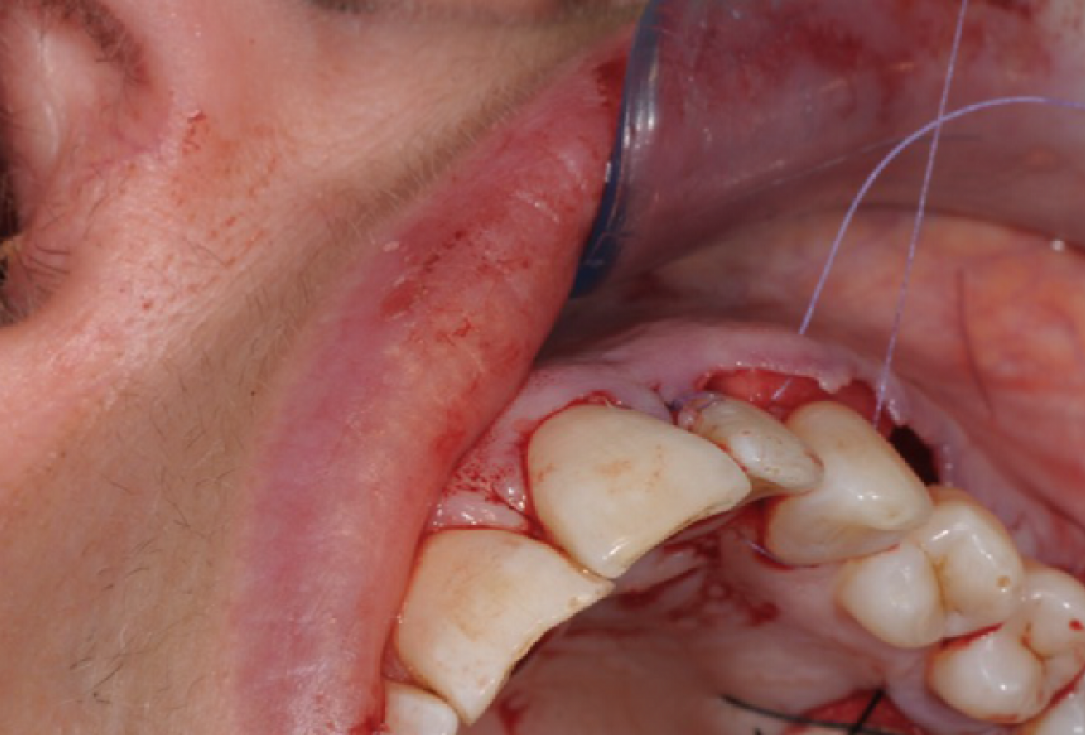 Multiple gingival recessions treated by MCAF in conjunction with mucoderm®, Straumann® Emdogain® and CTG - Benvenuto