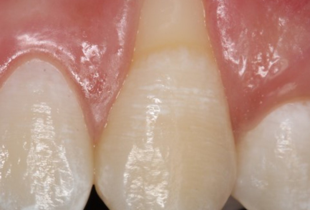 Isolated gingival recessions treated by CAF in conjunction with mucoderm® and Straumann® Emdogain® - Taba Jr