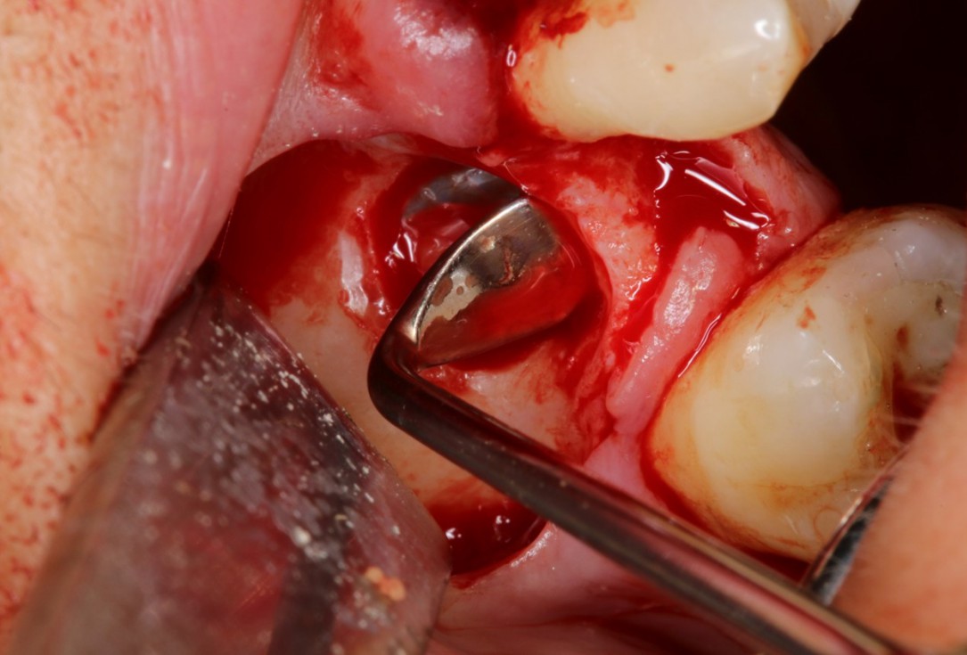Sinus Floor Elevation with maxgraft® bonering - Dr. B. Giesenhagen