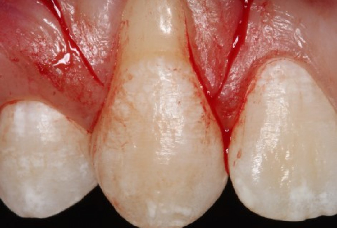 Isolated gingival recessions treated by CAF in conjunction with mucoderm® and Straumann® Emdogain® - Taba Jr