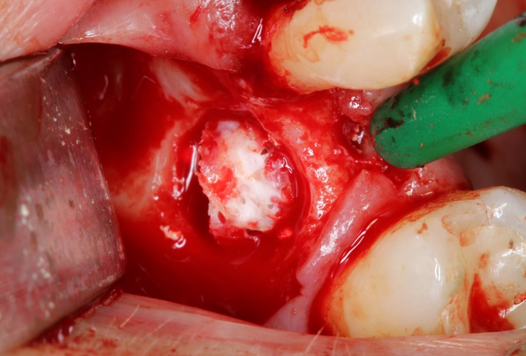 Sinus Floor Elevation with maxgraft® bonering - Dr. B. Giesenhagen