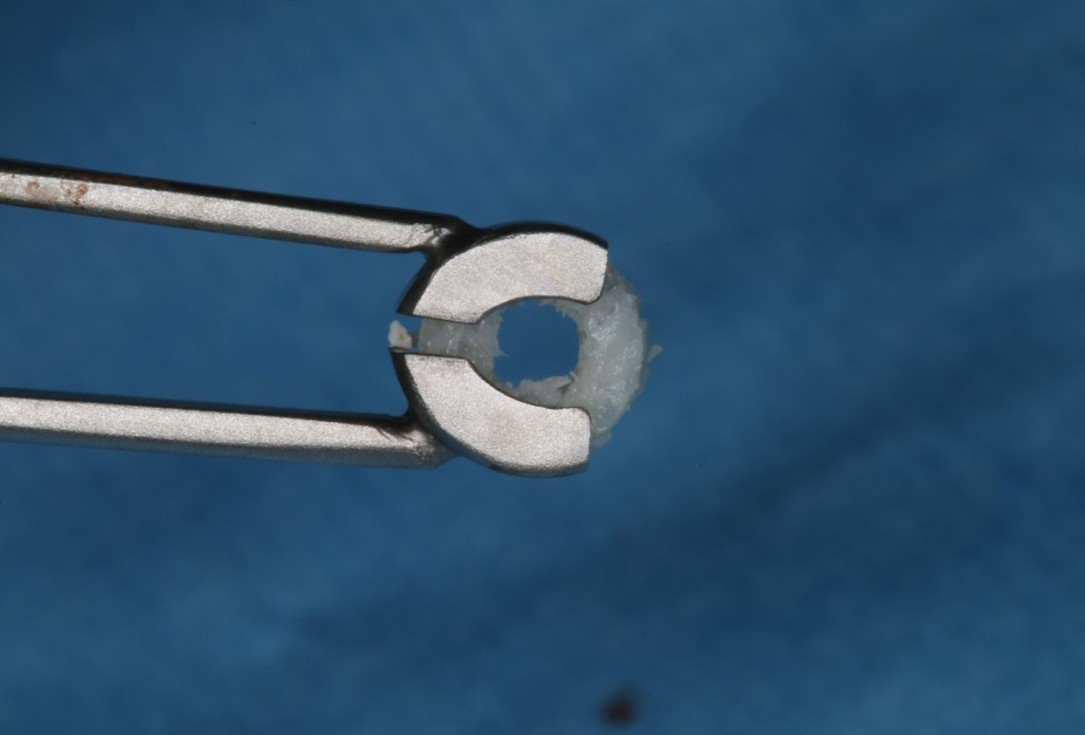 Sinus Floor Elevation with maxgraft® bonering - Dr. B. Giesenhagen