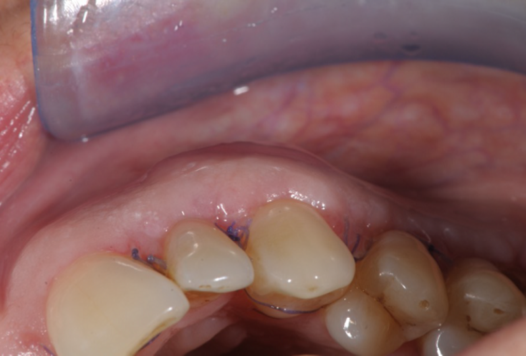 Multiple gingival recessions treated by MCAF in conjunction with mucoderm®, Straumann® Emdogain® and CTG - Benvenuto
