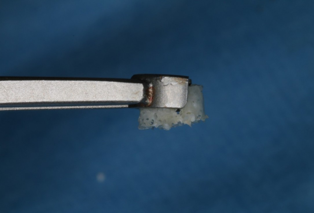 Sinus Floor Elevation with maxgraft® bonering - Dr. B. Giesenhagen