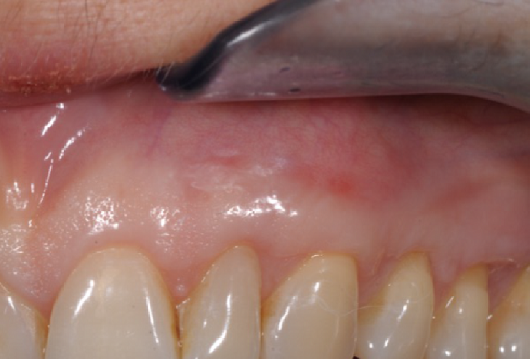 Multiple gingival recessions treated by MCAF in conjunction with mucoderm®, Straumann® Emdogain® and CTG - Benvenuto