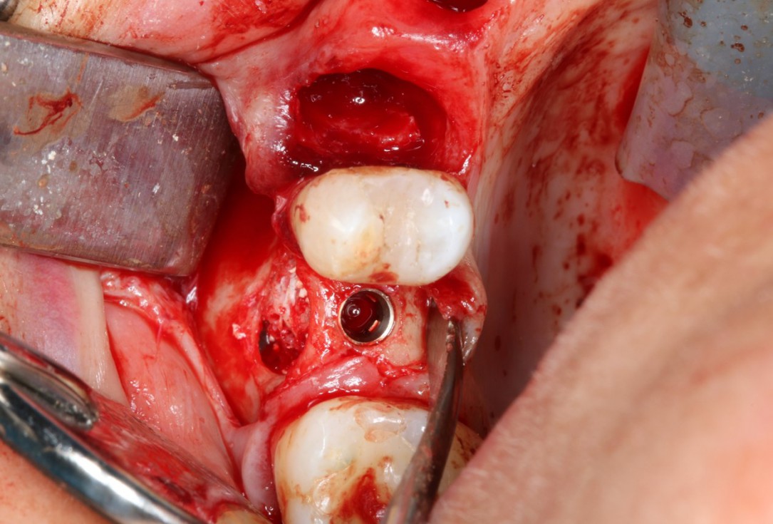 Sinus Floor Elevation with maxgraft® bonering - Dr. B. Giesenhagen