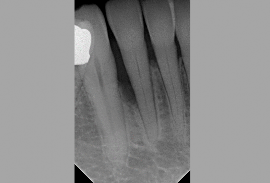 Non-contained intrabony defect treated using Straumann® Emdogain® and bone graft - Kasaj