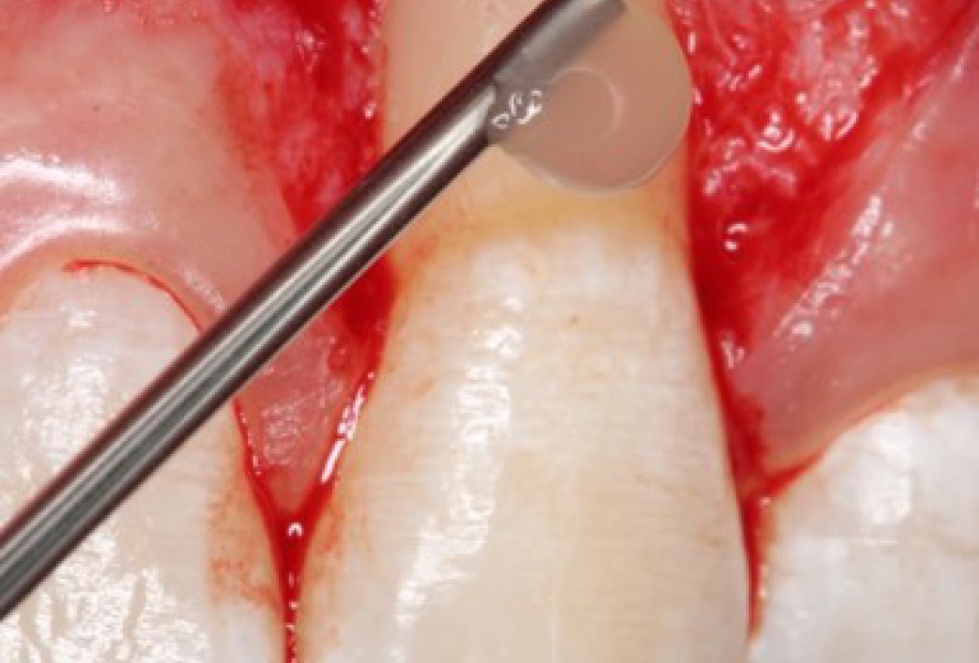 Isolated gingival recessions treated by CAF in conjunction with mucoderm® and Straumann® Emdogain® - Taba Jr