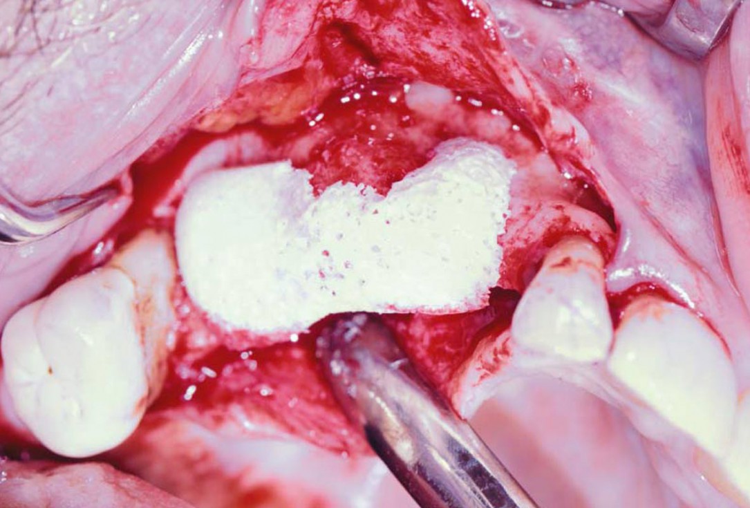 Ridge augmentation with maxgraft® bonebuilder and sinus floor elevation – Dr. K.P. Schiechl