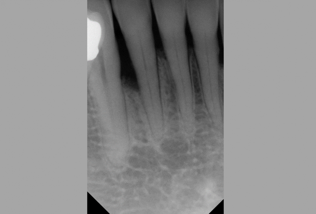 Non-contained intrabony defect treated using Straumann® Emdogain® and bone graft - Kasaj