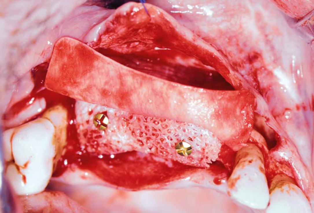 Ridge augmentation with maxgraft® bonebuilder and sinus floor elevation – Dr. K.P. Schiechl