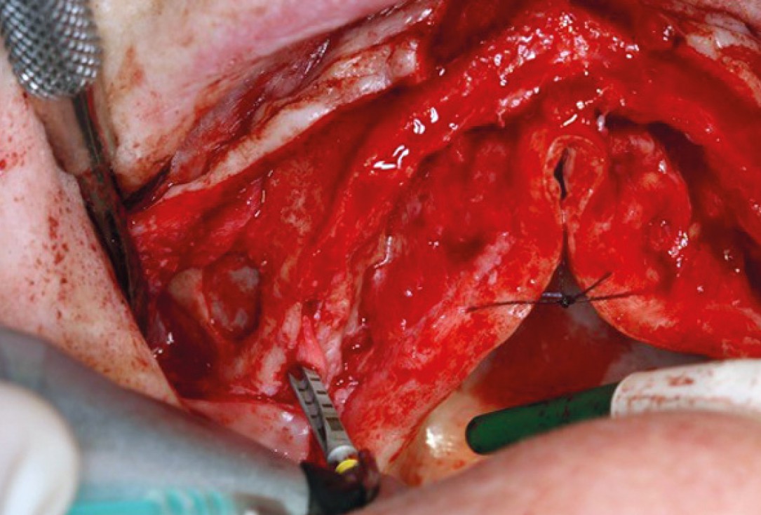 botiss maxresorb® inject for sinus lift - clinical case