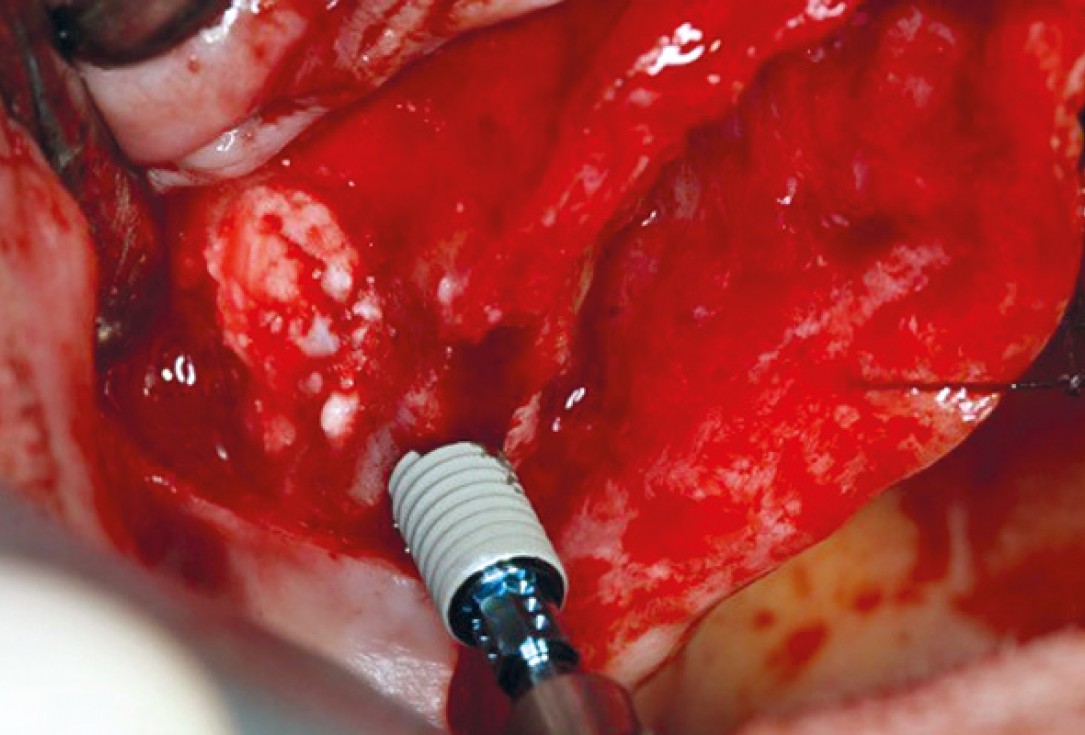 botiss maxresorb® inject for sinus lift - clinical case