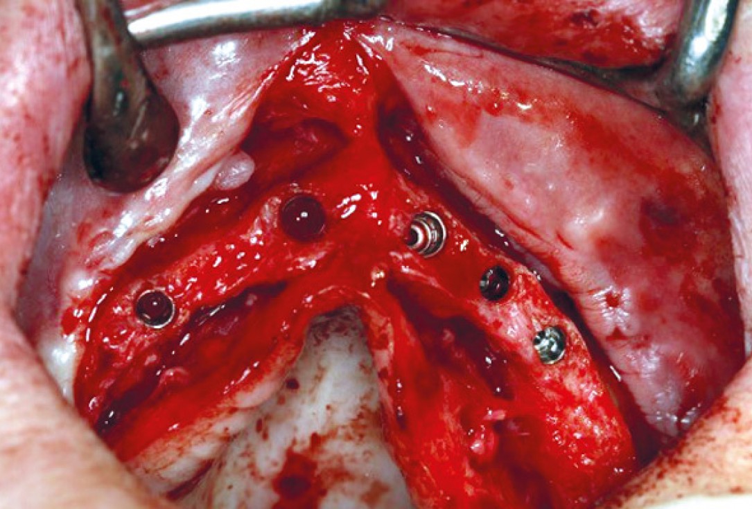 botiss maxresorb® inject for sinus lift - clinical case