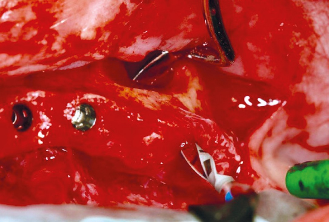 botiss maxresorb® inject for sinus lift - clinical case