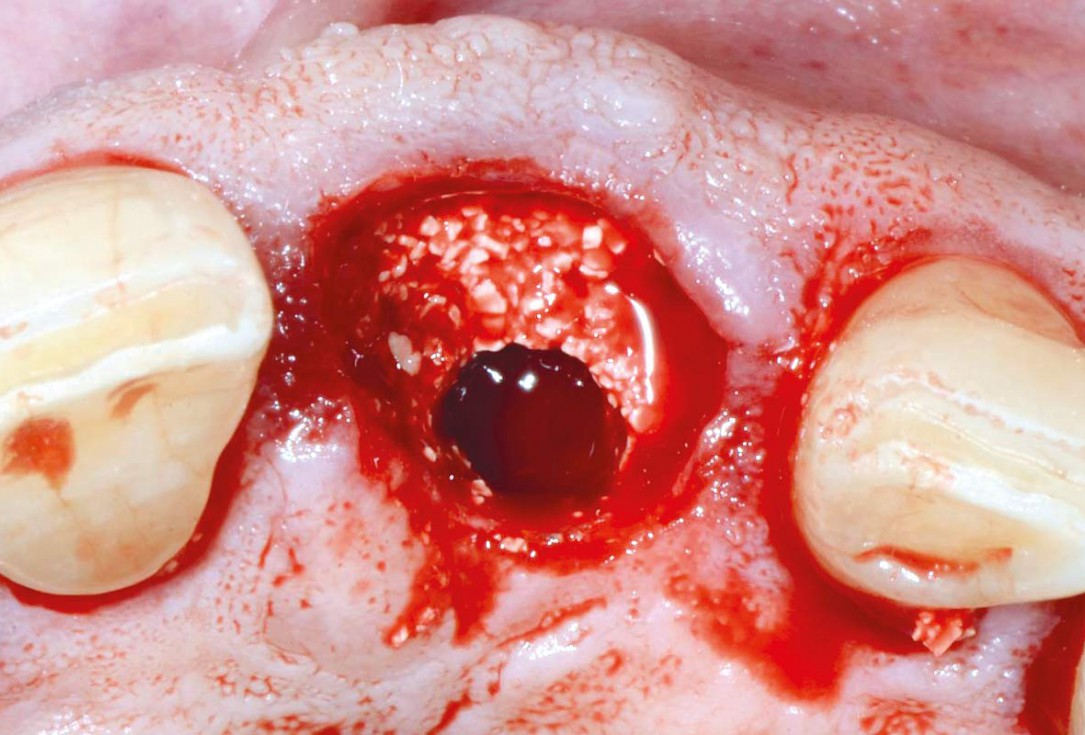 Immediate implant placement using cerabone® and collagen fleece - Dr. D. Jelušić