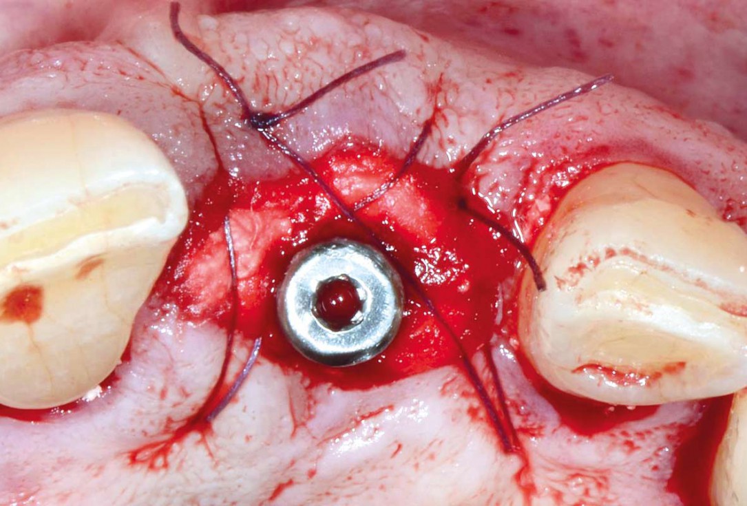 Immediate implant placement using cerabone® and collagen fleece - Dr. D. Jelušić