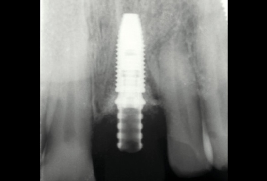 Immediate implant placement using cerabone® and collagen fleece - Dr. D. Jelušić