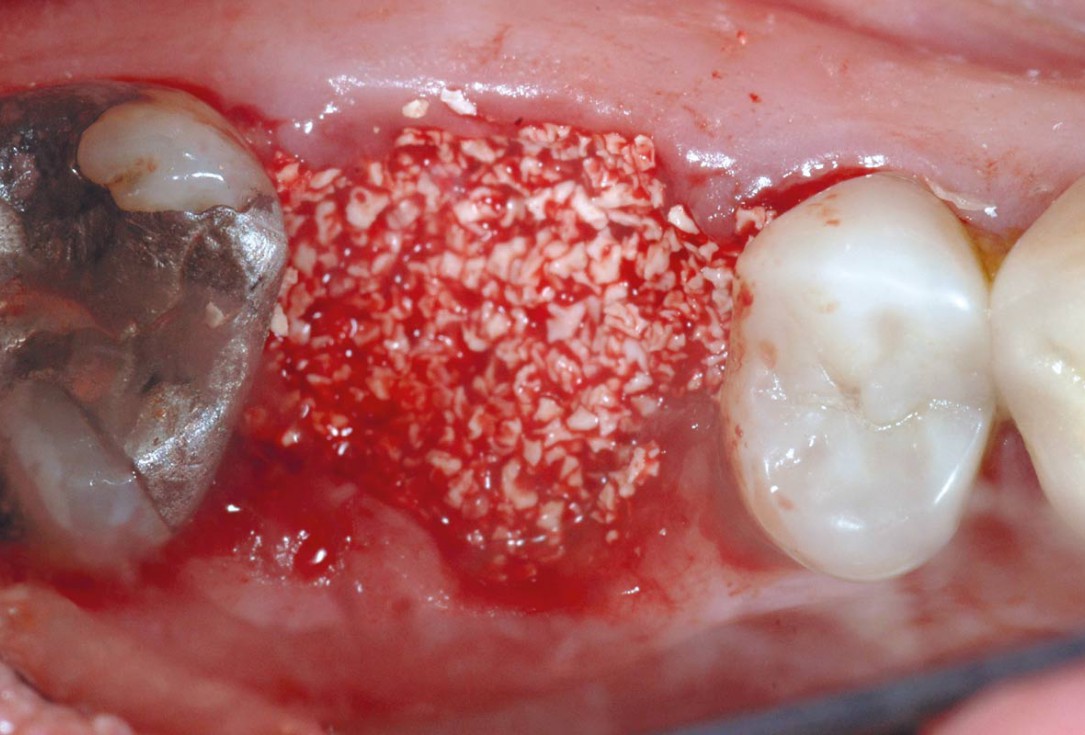 Socket preservation using cerbaone® and permamem® - Dr. A. Caiazzo