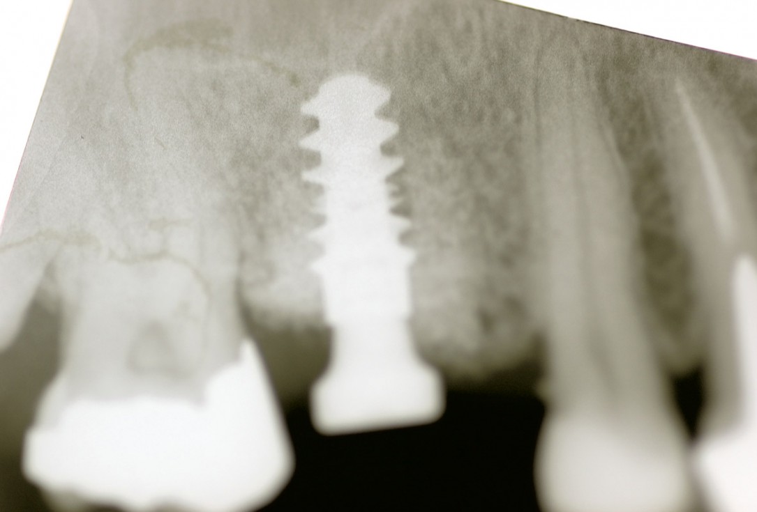 Socket preservation using cerbaone® and permamem® - Dr. A. Caiazzo