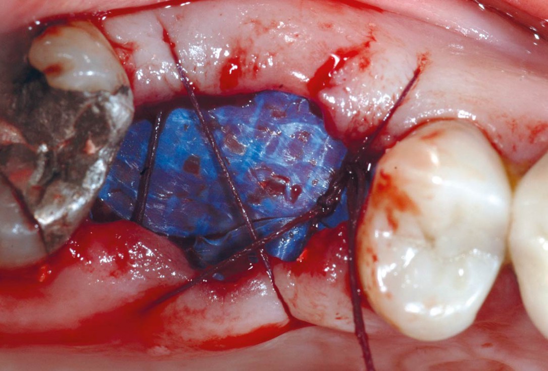 Socket preservation using cerbaone® and permamem® - Dr. A. Caiazzo