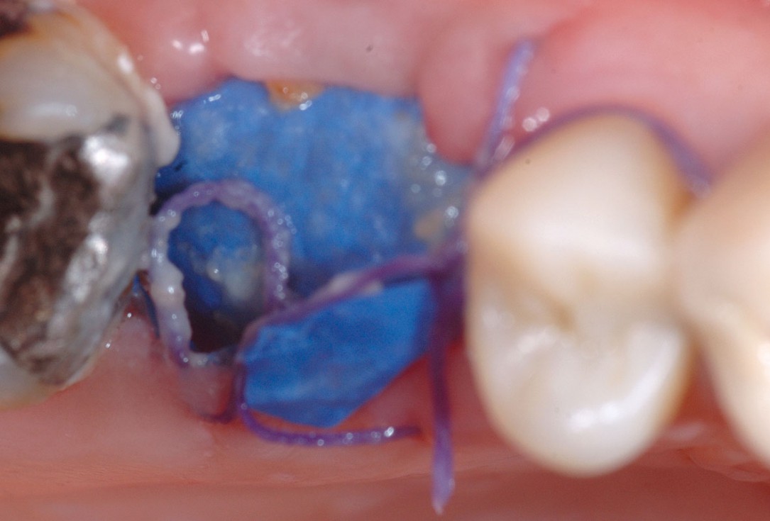 Socket preservation using cerbaone® and permamem® - Dr. A. Caiazzo