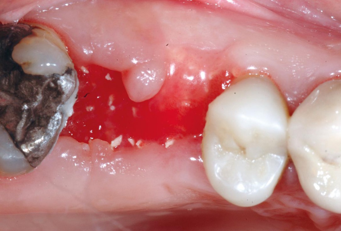 Socket preservation using cerbaone® and permamem® - Dr. A. Caiazzo