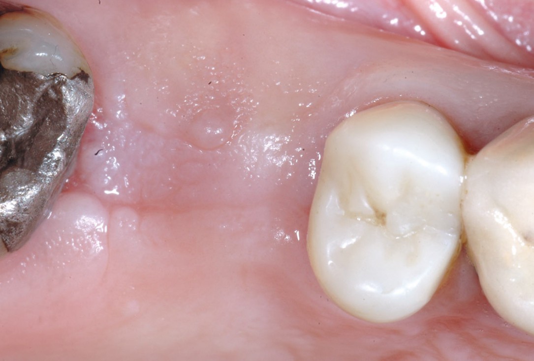 Socket preservation using cerbaone® and permamem® - Dr. A. Caiazzo