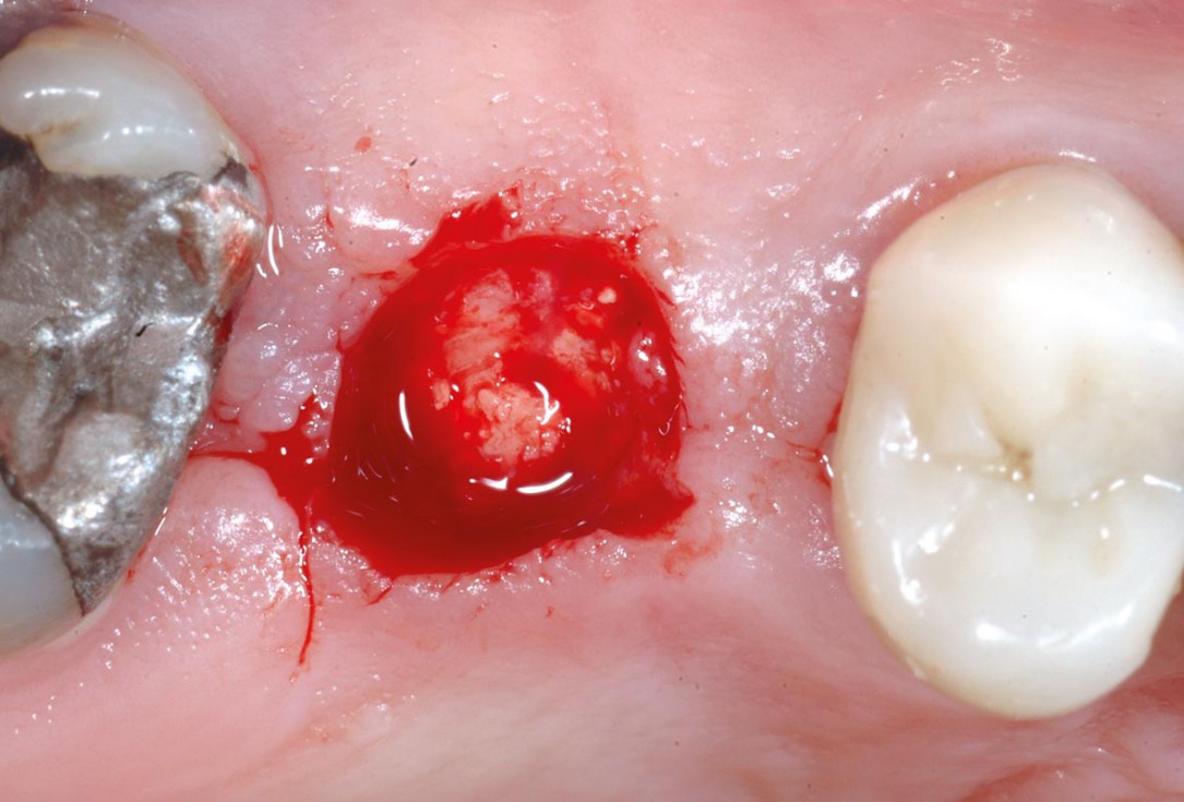 Socket preservation using cerbaone® and permamem® - Dr. A. Caiazzo