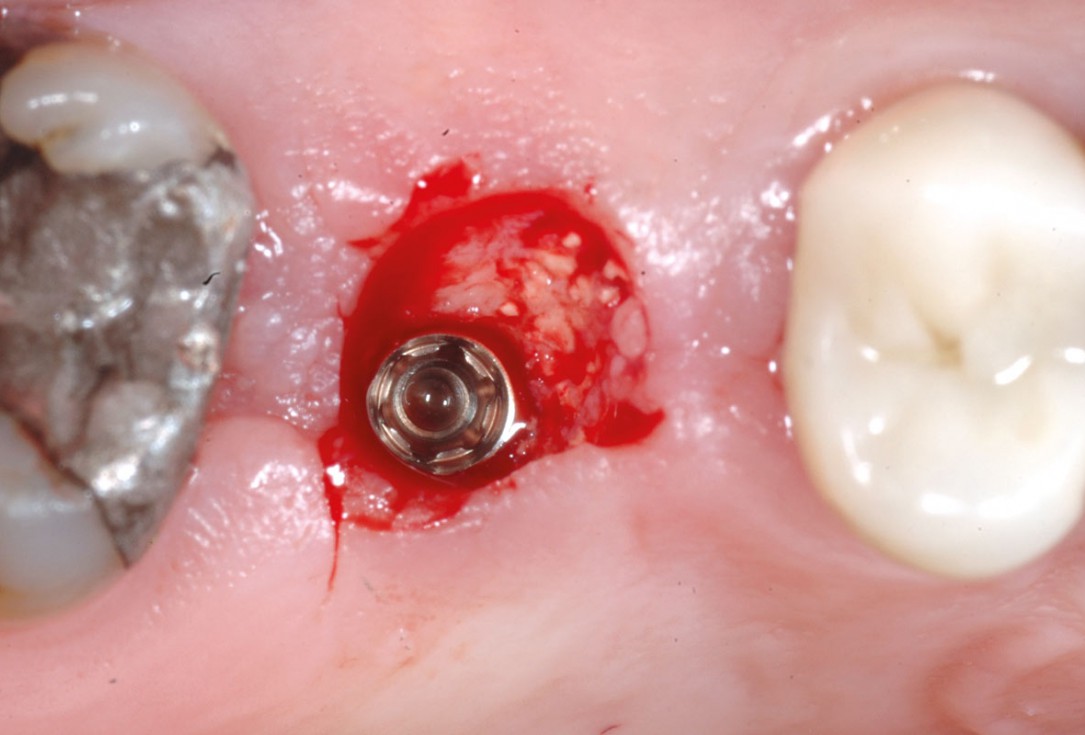 Socket preservation using cerbaone® and permamem® - Dr. A. Caiazzo