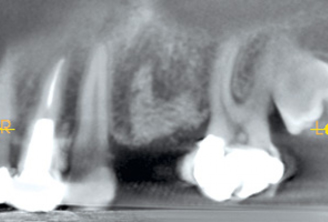 Socket preservation using cerbaone® and permamem® - Dr. A. Caiazzo