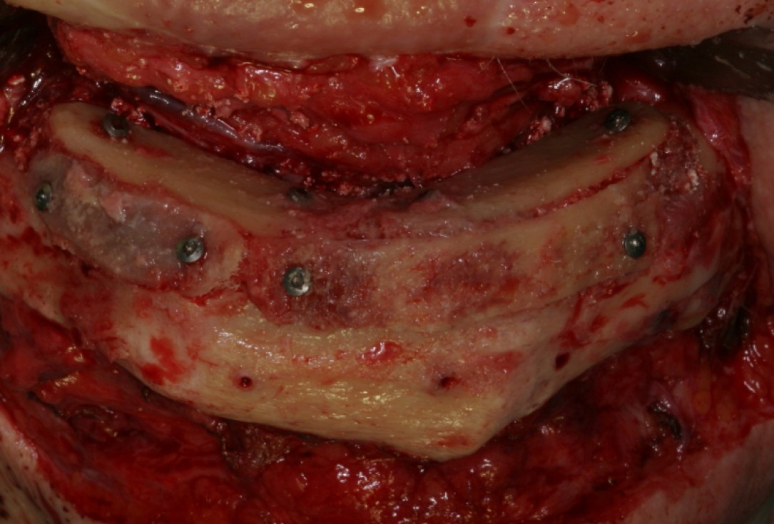 Block augmentation with maxresorb®, collprotect® membrane & autologous bone blocks - Prof. Dr. Dr. D. Rothamel